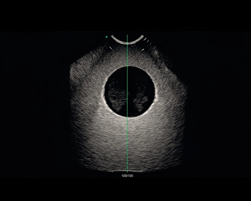 Ultrosound Needle Guidance