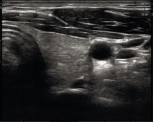 B-mode ultrasound image of the thyroid gland