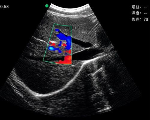 Color Doppler ultrasound image of liver blood flow