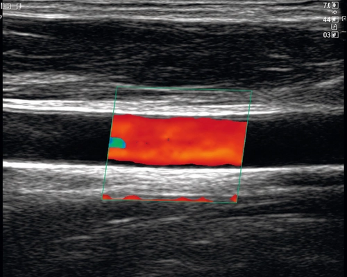 Color Doppler ultrasound image of blood flow in a vessel